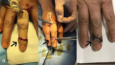 Treatment of Mucous Cyst of the Distal Interphalangeal Joint With Osteophyte Excision and Joint Debridement